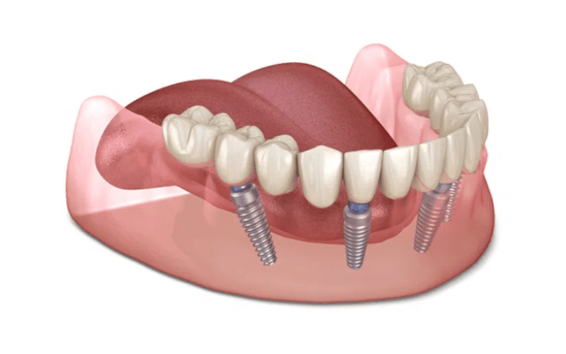 Trồng Răng Implant All-On-4