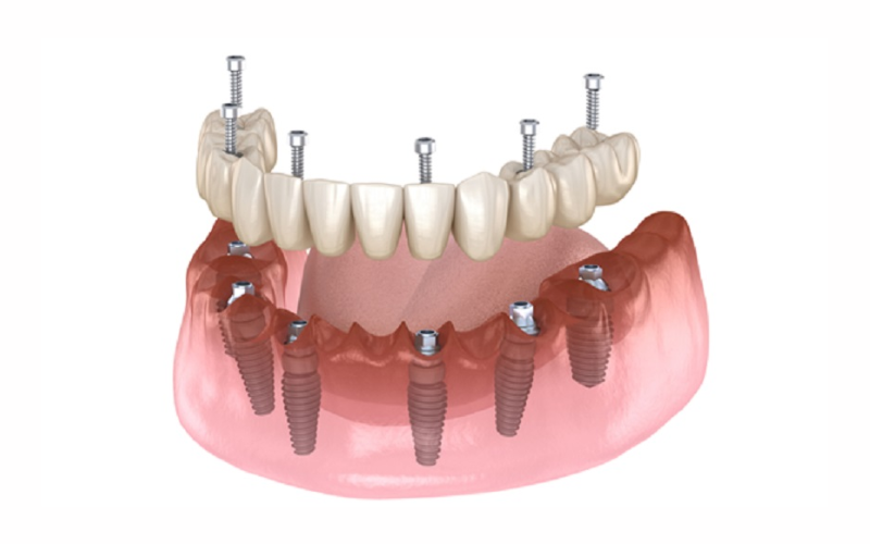 Mô phỏng kỹ thuật trồng răng Implant All-on-6