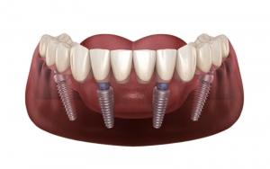 Advantages of All-on-4 Dental Implants