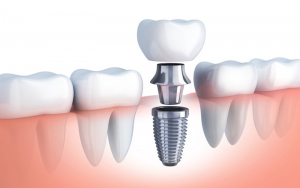 Trụ Implant