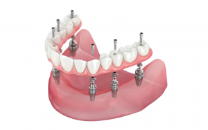 Simulation of the All-on-6 Dental Implants Technique