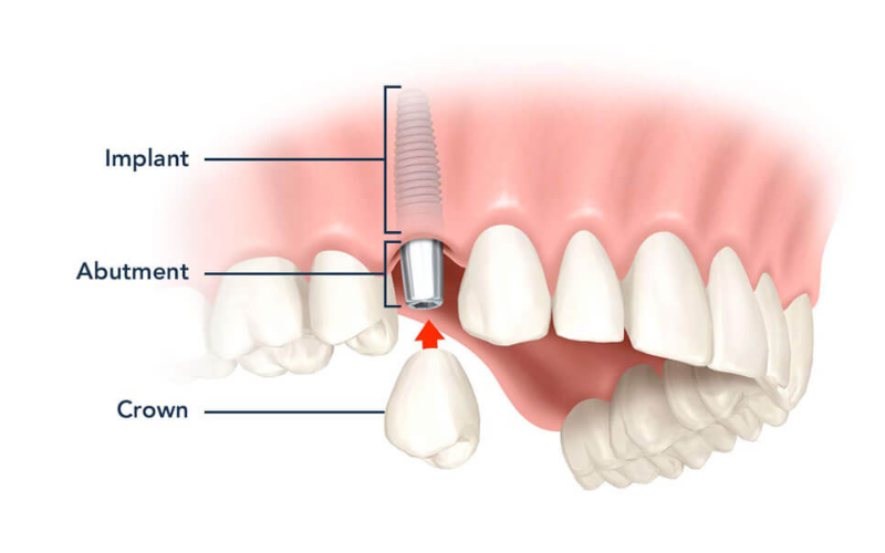 Ưu điểm vượt trội của trồng răng Implant