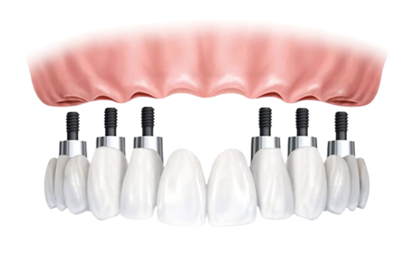 Trường hợp có thể trồng răng Implant All-on-6
