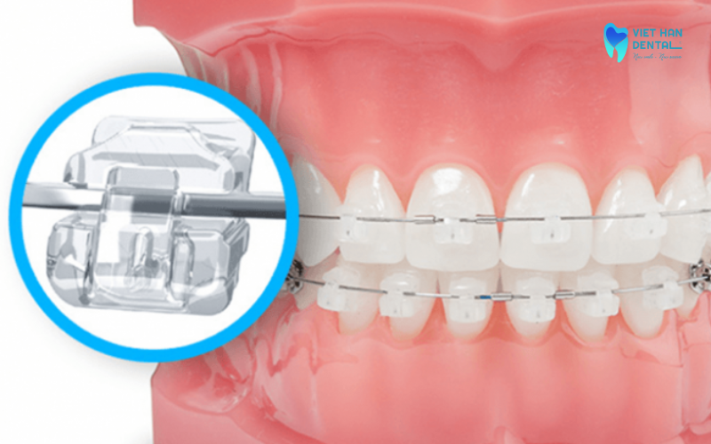 Mắc cài sứ tự động