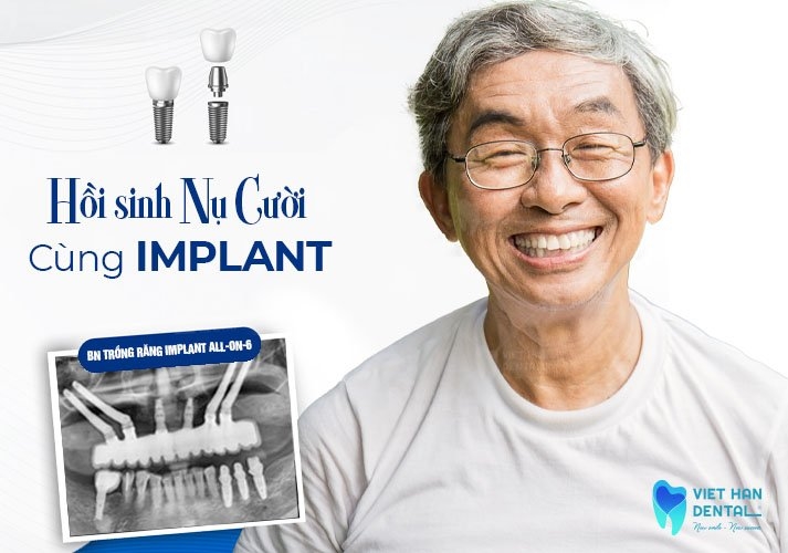 Benh Nhan Trong Rang Implant All On 6