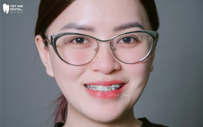 Khách hàng có tình trạng răng chen chúc đang điều trị tại Nha khoa Việt Hàn