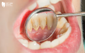 Cạo vôi răng
