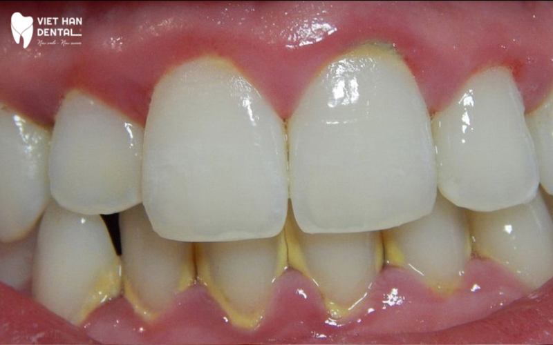 Làm thế nào để hạn chế vôi răng?