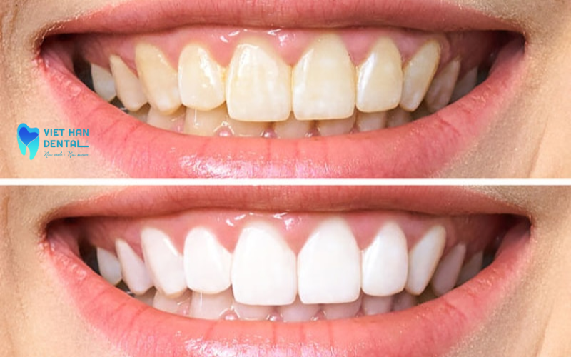 4Tẩy trắng răng dành cho những đối tượng nào? 