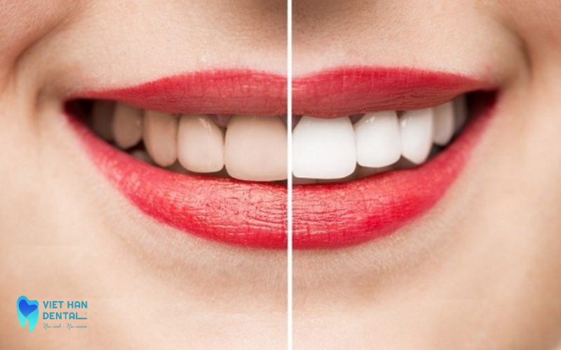 Ê răng là tác dụng phụ của tẩy trắng răng