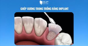 Ghép xương trong trồng răng Implant