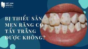 Bi Thieu San Men Rang Co Tay Trang Duoc Khong