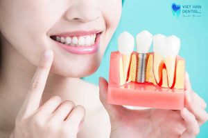 How Long Do Dental Implant Last 1