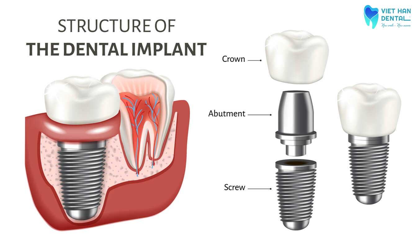 The structure of dental implants 