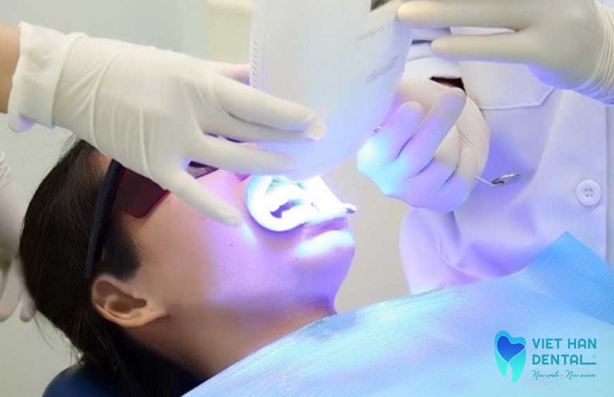 Tẩy trắng răng tại nha khoa 