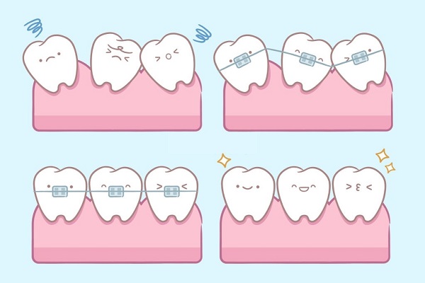 Cơ chế hoạt động của niềng răng 