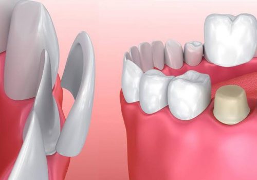 The Difference Between Porcelain Crowns And Dental Veneers 3
