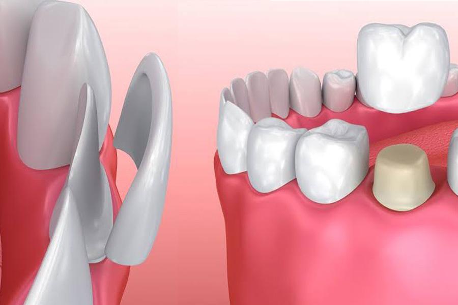 The Difference Between Porcelain Crowns And Dental Veneers 3