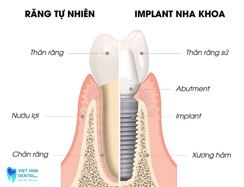 Cấu trúc của răng Implant 