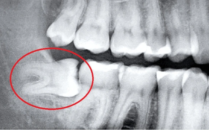 Chụp X quang phát hiện tình trạng răng khôn mọc ngầm