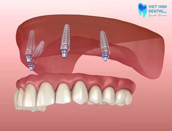Trồng răng Implant All-on-4