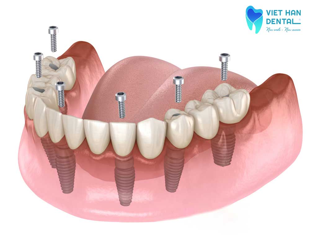 Trồng răng Implant All-on-6
