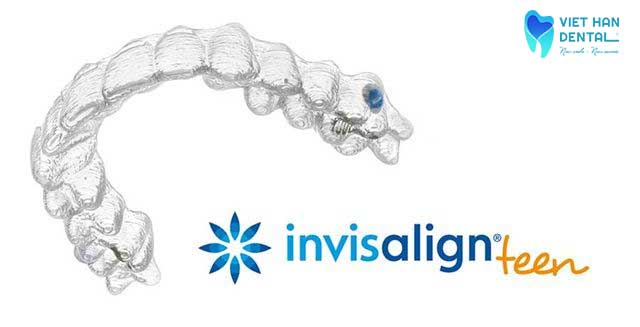Niềng răng Inisalign for Teen 