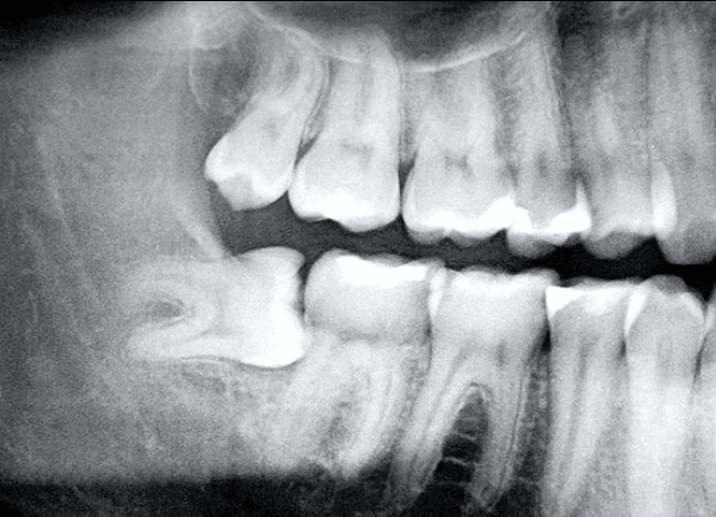 Chụp X - quang răng khôn mọc lệch 90 độ - Nhổ răng khôn Nha Trang 
