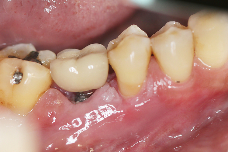 Răng Implant bị đào thải 