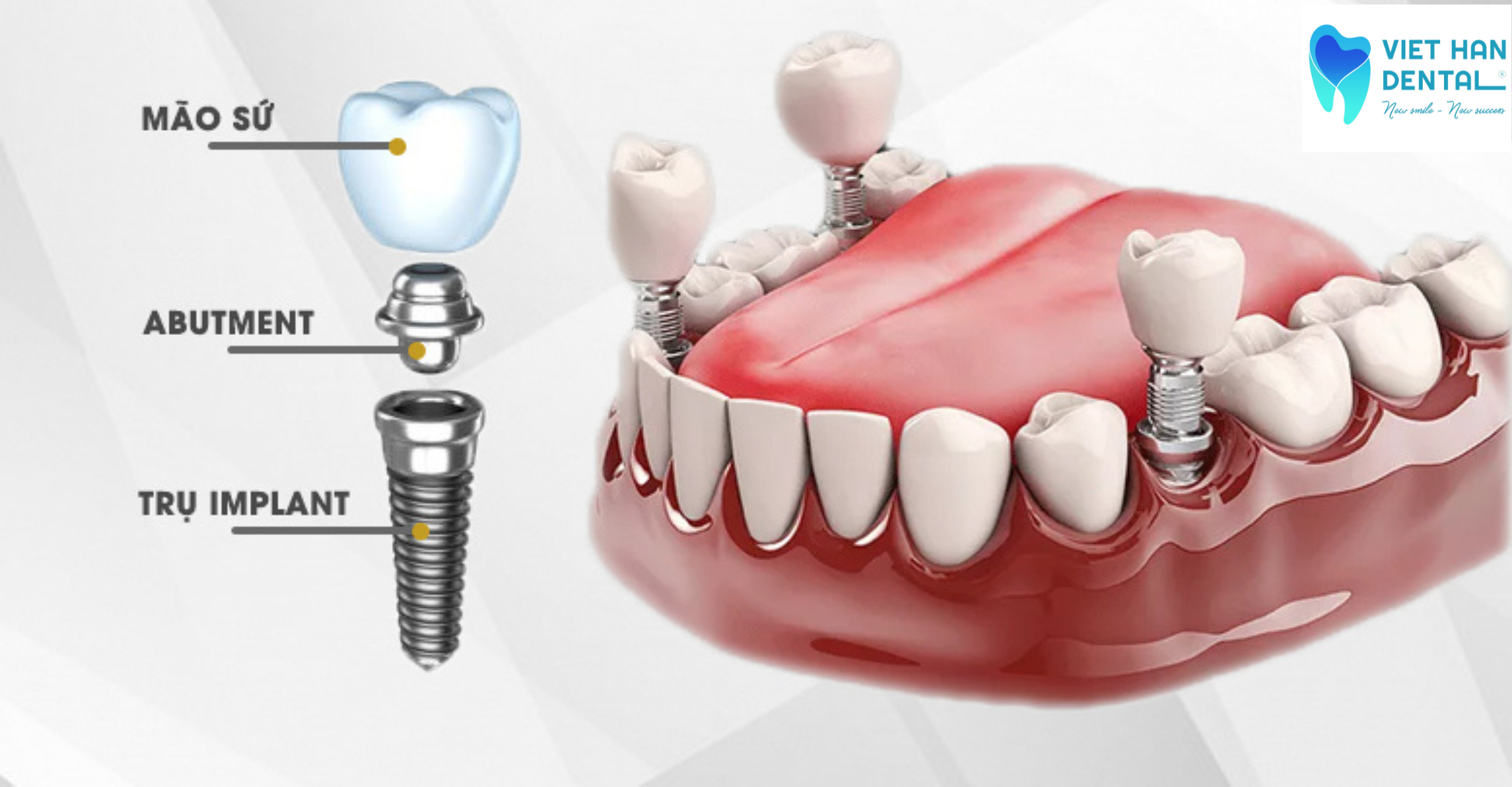 Cấu trúc của một răng Implant