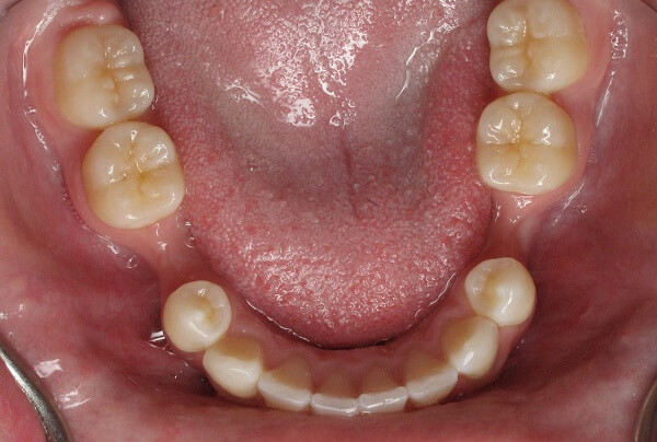  Răng bị tiêu xương hàm