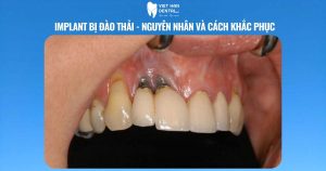 Implant bị đào thải - nguyên nhân và cách khắc phục| Trồng răng Implant Nha Trang