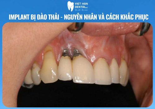 Implant bị đào thải – nguyên nhân và cách khắc phục| Trồng răng Implant Nha Trang