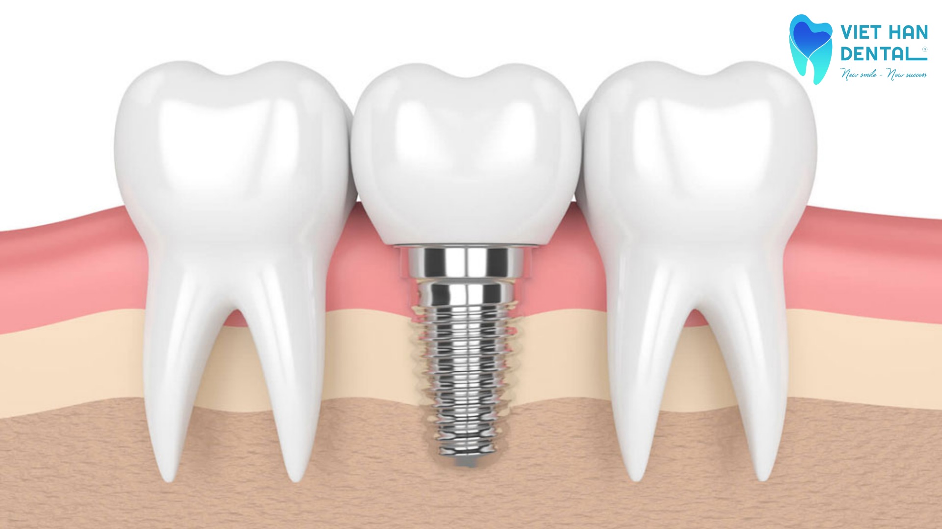 Răng Implant nằm giữa hai răng thật 