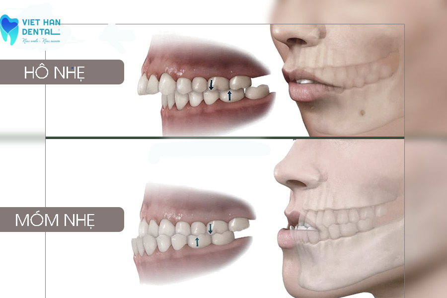 Răng hàm trên hơi đưa về phía trước