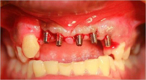 Răng bị chảy máu sau khi cắm trụ Implant kém chất lượng