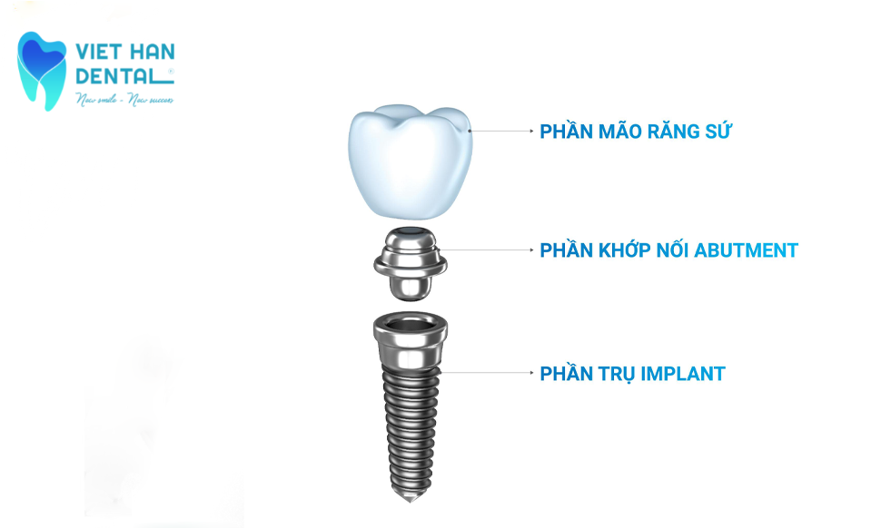 Cấu tạo của một răng Implant