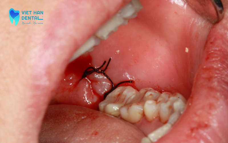 Khâu miệng vết thương sau khi nhổ răng 