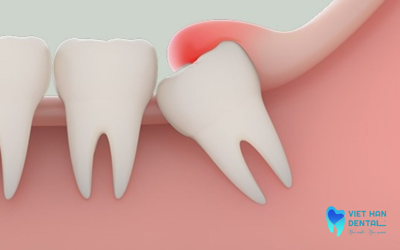 Nhiễm trùng và viêm lợi quanh răng khôn