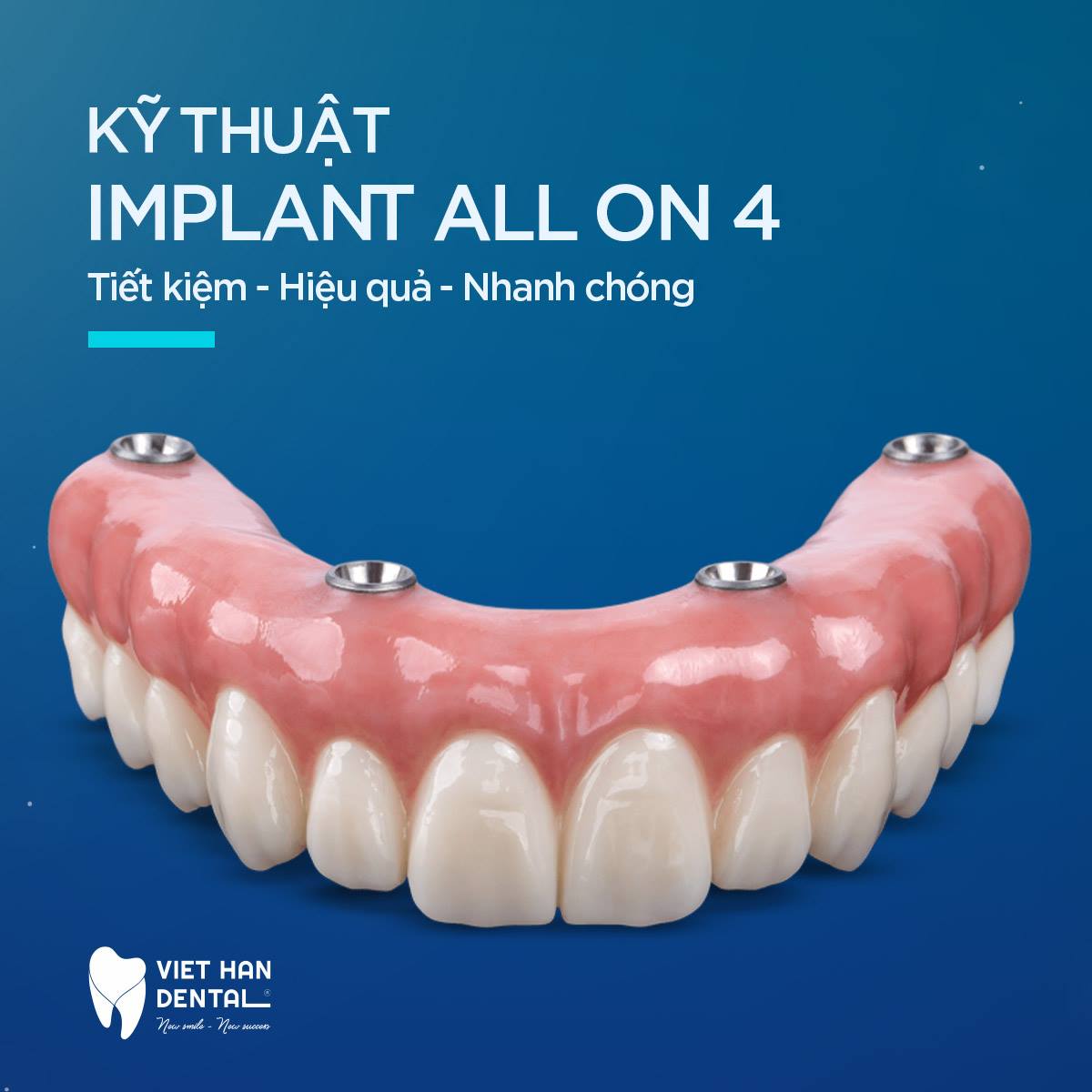 co-so-cay-ghep-implant-uy-tin-tai-Nha-Trang
