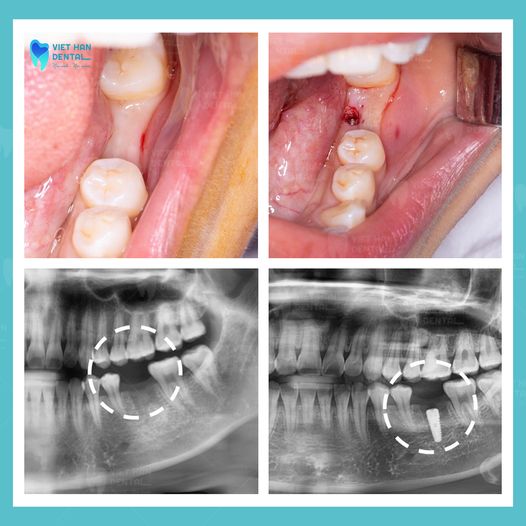 trồng răng implant Nha Trang tháng 3/2023