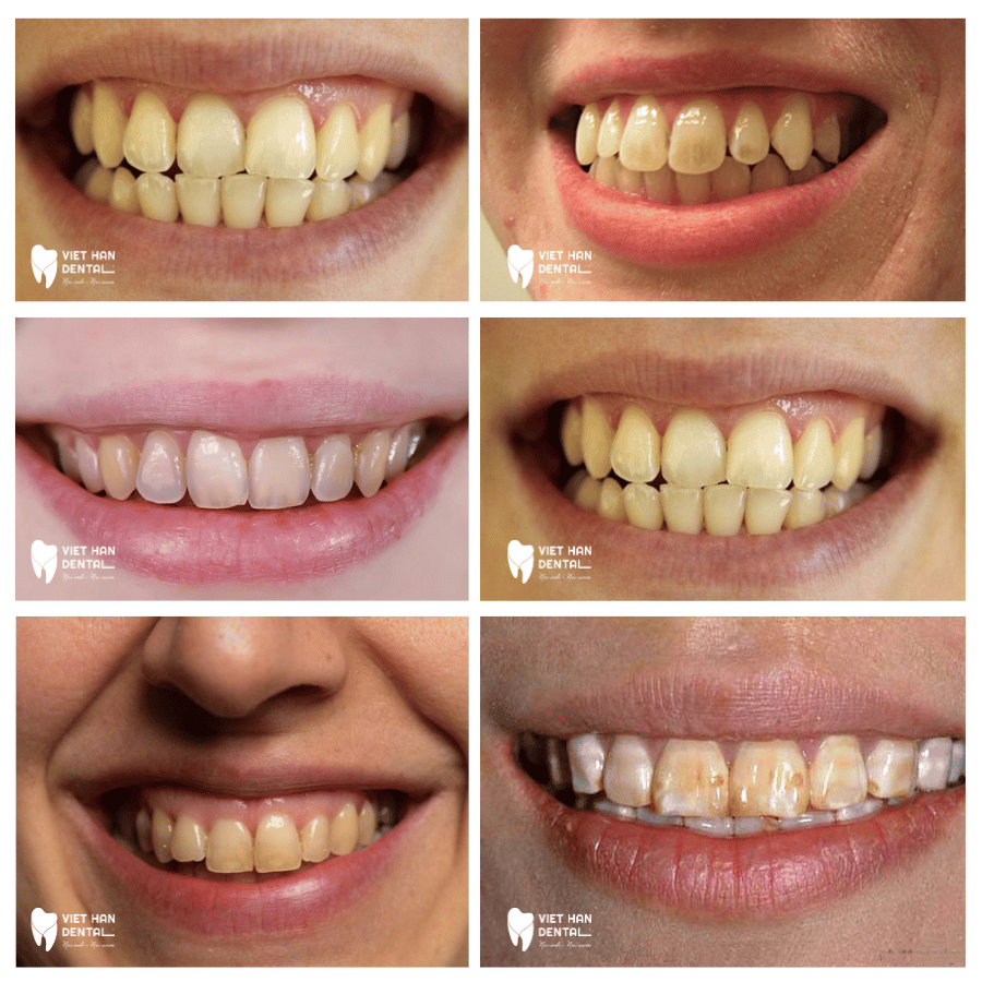 Nguyên nhân gây răng nhiễm màu ở sâu trong cấu trúc