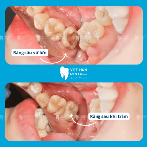 Kết quả hàn trám răng chuẩn Y khoa tại Nha khoa Việt Hàn