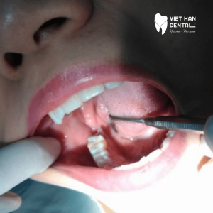 Tại sao có sự khác biệt giá khi nhổ răng khôn tại Nha Trang?