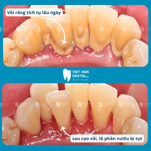 Hình ảnh trước và sau khi cạo vôi răng tại Nha khoa Việt Hàn