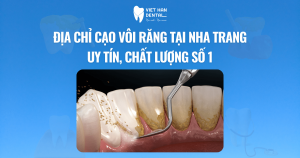 Địa chỉ cạo vôi răng tại Nha Trang uy tín, chất lượng số 1
