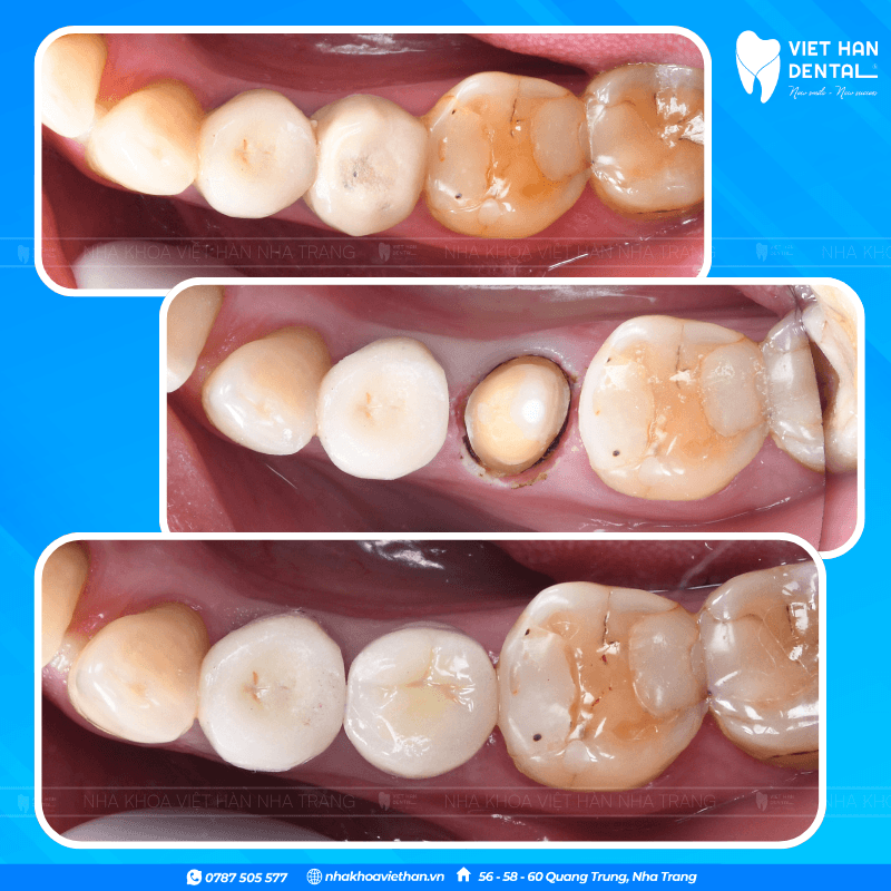 Bọc răng sứ bảo tồn tối đa răng thật