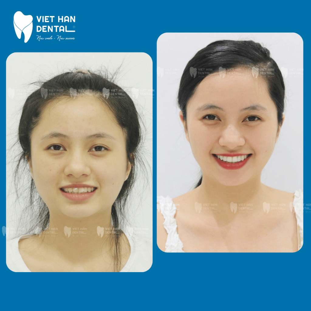 Hình ảnh khách hàng trước - sau khi niềng răng tại Nha khoa Việt Hàn Nha Trang