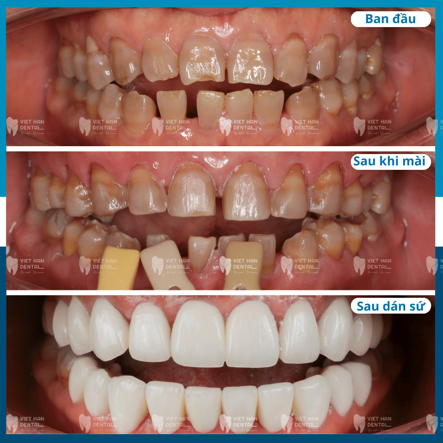 Tình trạng răng của khách hàng trước và sau khi dán sứ veneer tại Nha hoa Việt Hàn