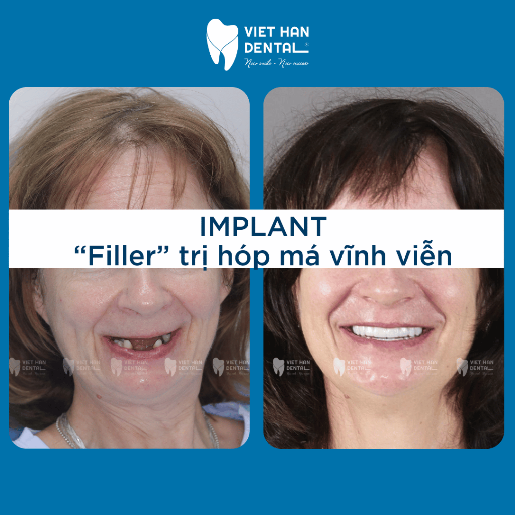 Hình ảnh khách hàng trước - sau khi trồng răng implant tại Nha khoa Việt Hàn Nha Trang